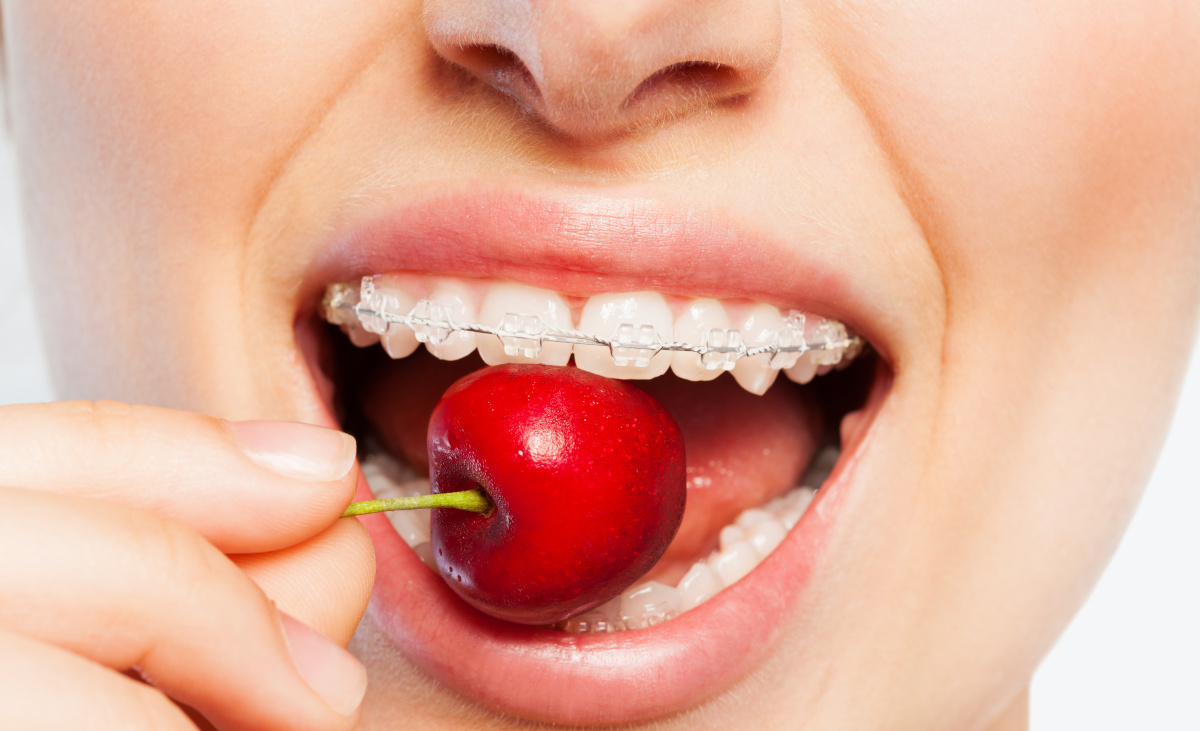 Close-up of woman's mouth with clear orthodontic brackets biting off ripe cherry