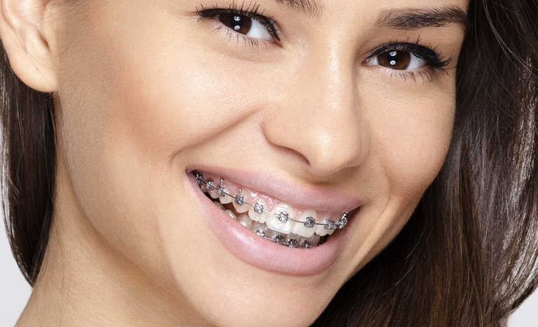 Young woman with braces and toothbrush and braces brush cleaner
